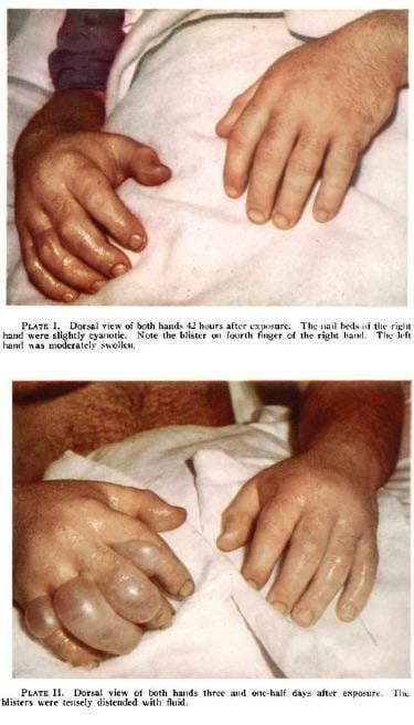 accute radiation image louis slotin and harry